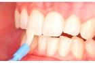 Лечение эмали зубов (1 челюсть)