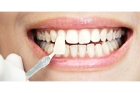 Косметическое восстановление зуба виниром