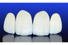 Восстановление формы зуба
