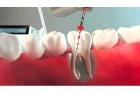 Пломбирование двухканального зуба