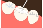 Пломбирование трехканального зуба