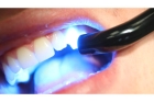 Пломбирование зуба световой пломбой