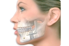 Операция на костной части челюсти