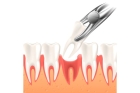 Удаление зуба двухкорневого (подвижный)