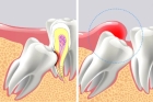 Удаление зуба трехкорневого (подвижный)