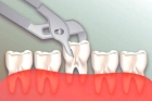 Удаление зуба двухкорневого