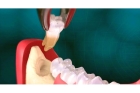 Удаление зуба “Мудрости”