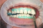 Отбеливание зубов системой Opalescence