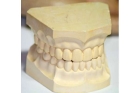 Слепки зубов для протезирования