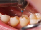Лечение кариеса 1 зуба
