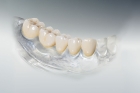 Металлокерамическая коронка на 6 зубов