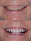 Металлокерамические коронки на жевательные зубы