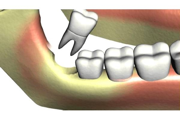 Удаление зуба однокорневого