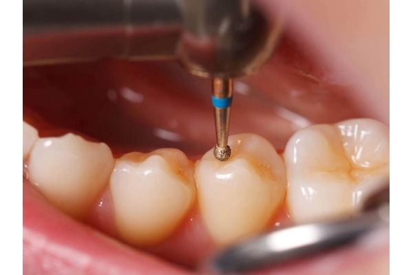 Лечение кариеса 1 зуба