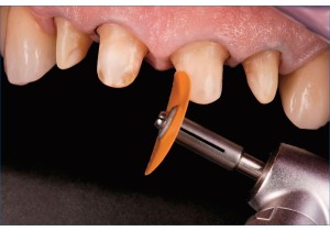Восстановление зуба под металлокерамической коронкой