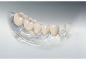 Металлокерамическая коронка на 6 зубов