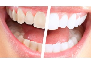 Отбеливание девитальных зубов