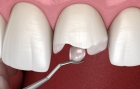 Художественная реставрация зубов пломбировочным материалом