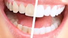 Отбеливание девитальных зубов