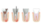 Лечение периодонтита трехканального зуба